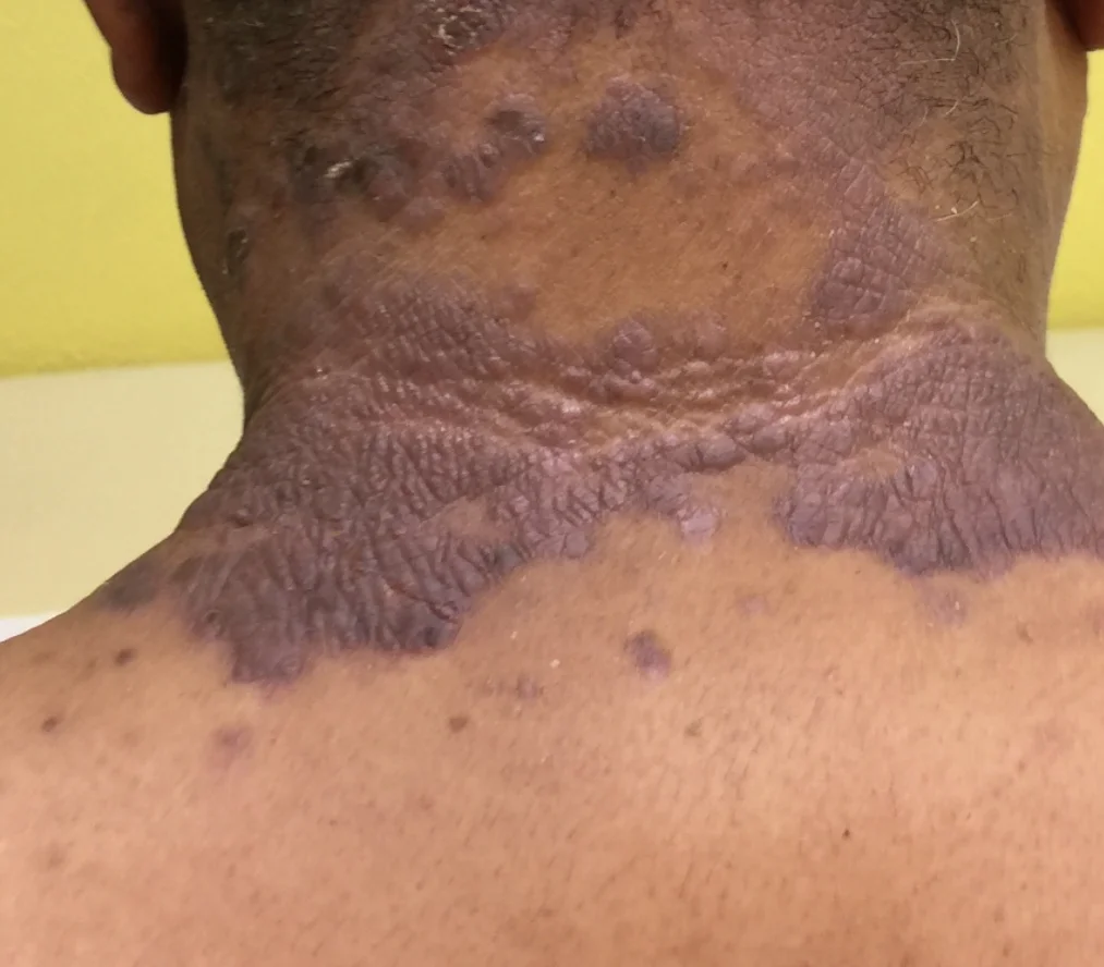 PSORIASIS | BEFORE