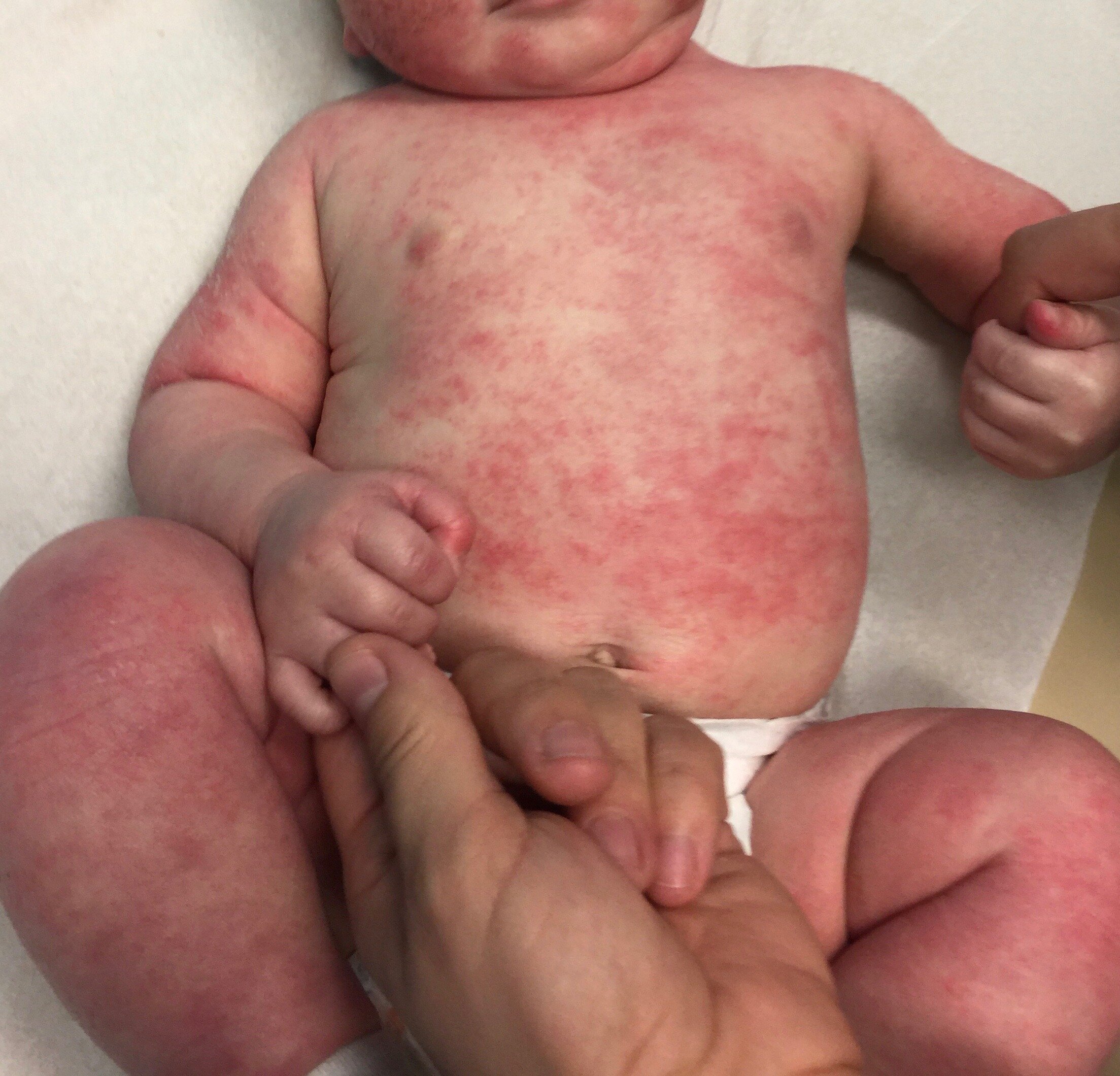 BEFORE | BABY ECZEMA SKIN CONDITION