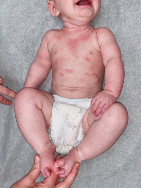 BEFORE | BABY ECZEMA SKIN CONDITION