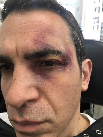 Bruise Chris Messina .jpg