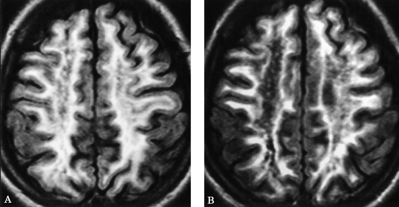 Vanishing White Matter Disease Image via Neurology.com