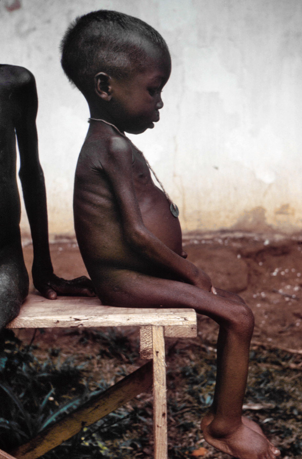 Image: Public Domain Image from https://en.wikipedia.org/wiki/Starvation#/media/File:Starved_girl.jpg