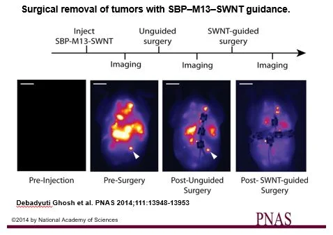 Figure 2: Using the probe to image during surgery, the researchers found more small and deeply embedded tumors. The white arrow points to a tumor that was only found and removed after imaging using the probe.
