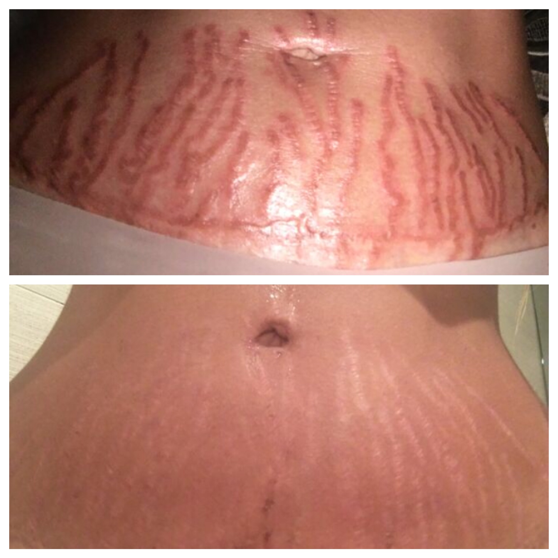 Stretch Mark Removal with Venus Viva Fractional