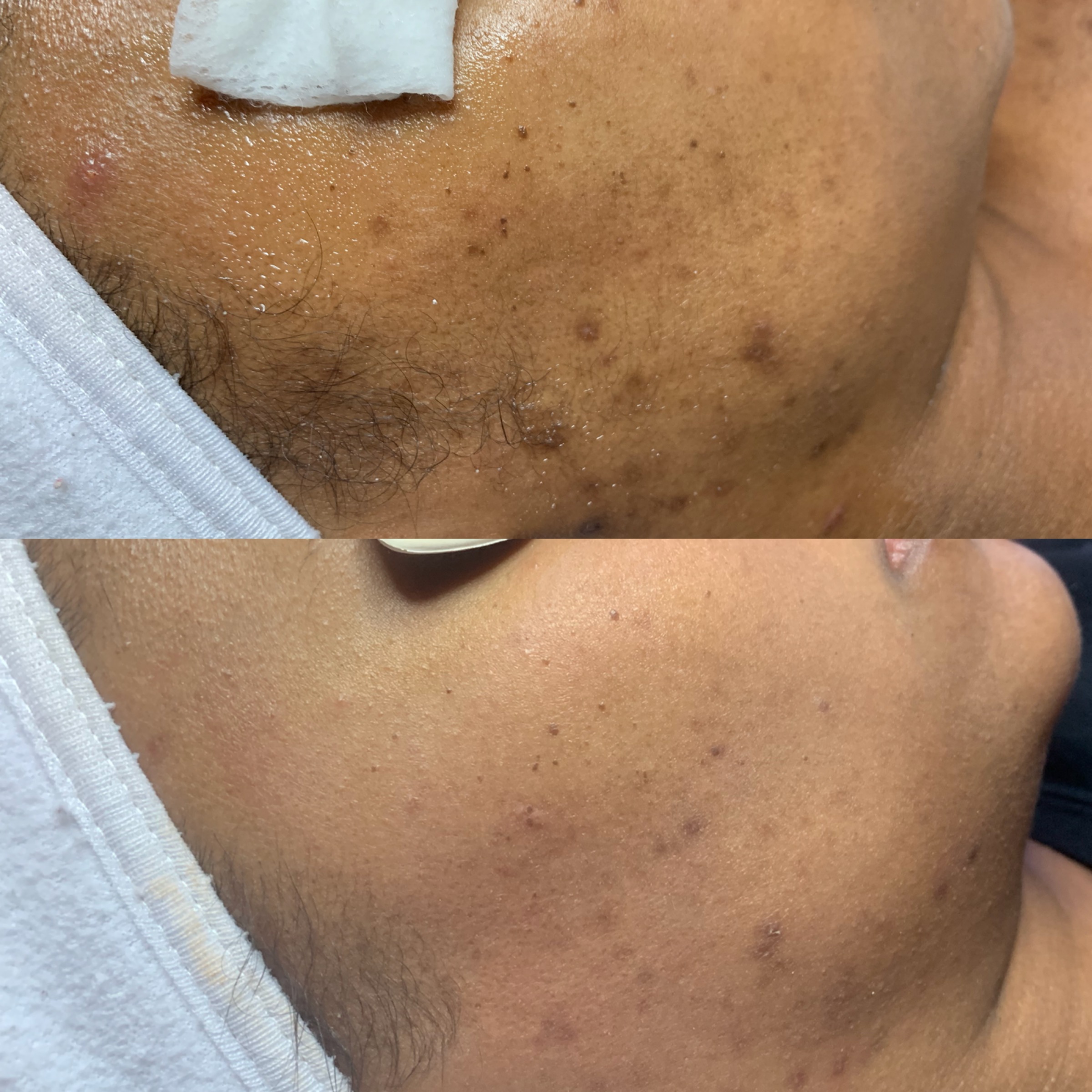 Brown Spot Removal with our Venus Versa