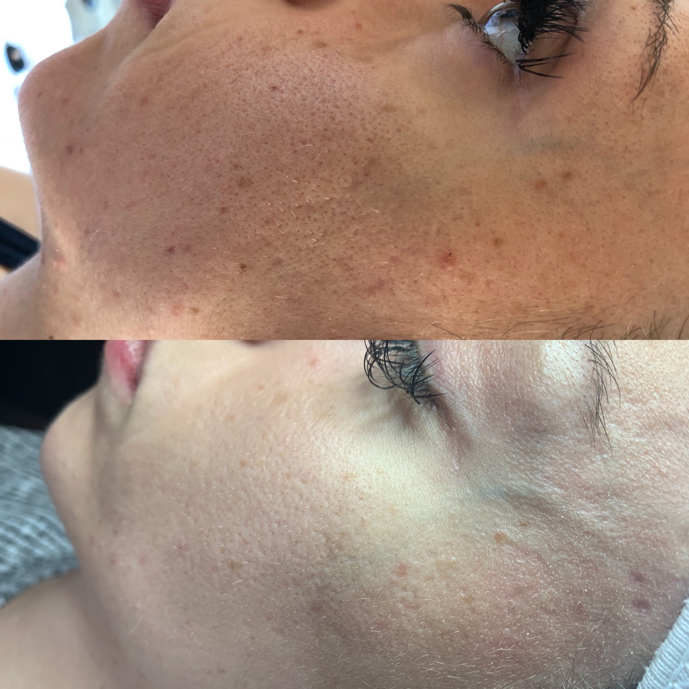 Brown Spot Removal with our Venus Versa