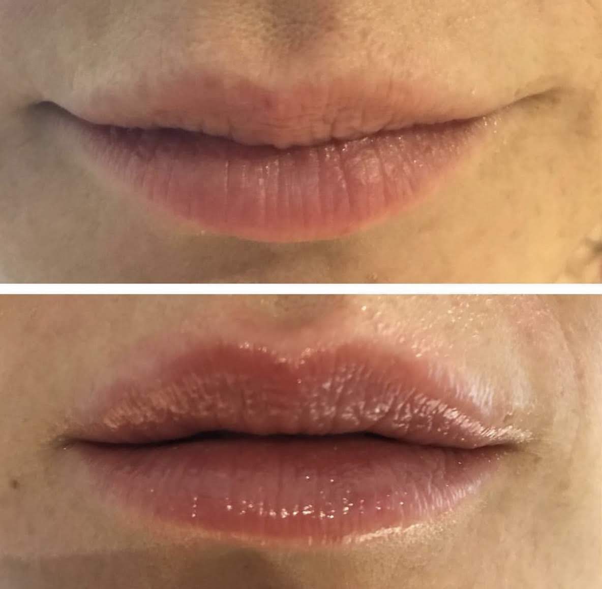 Laser Lip Rejuvenation with Aerolase Neo