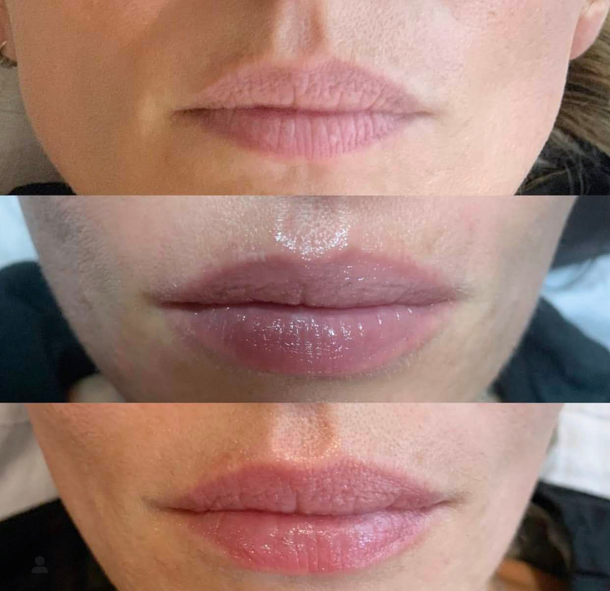 Laser Lip Rejuvenation with Aerolase Neo