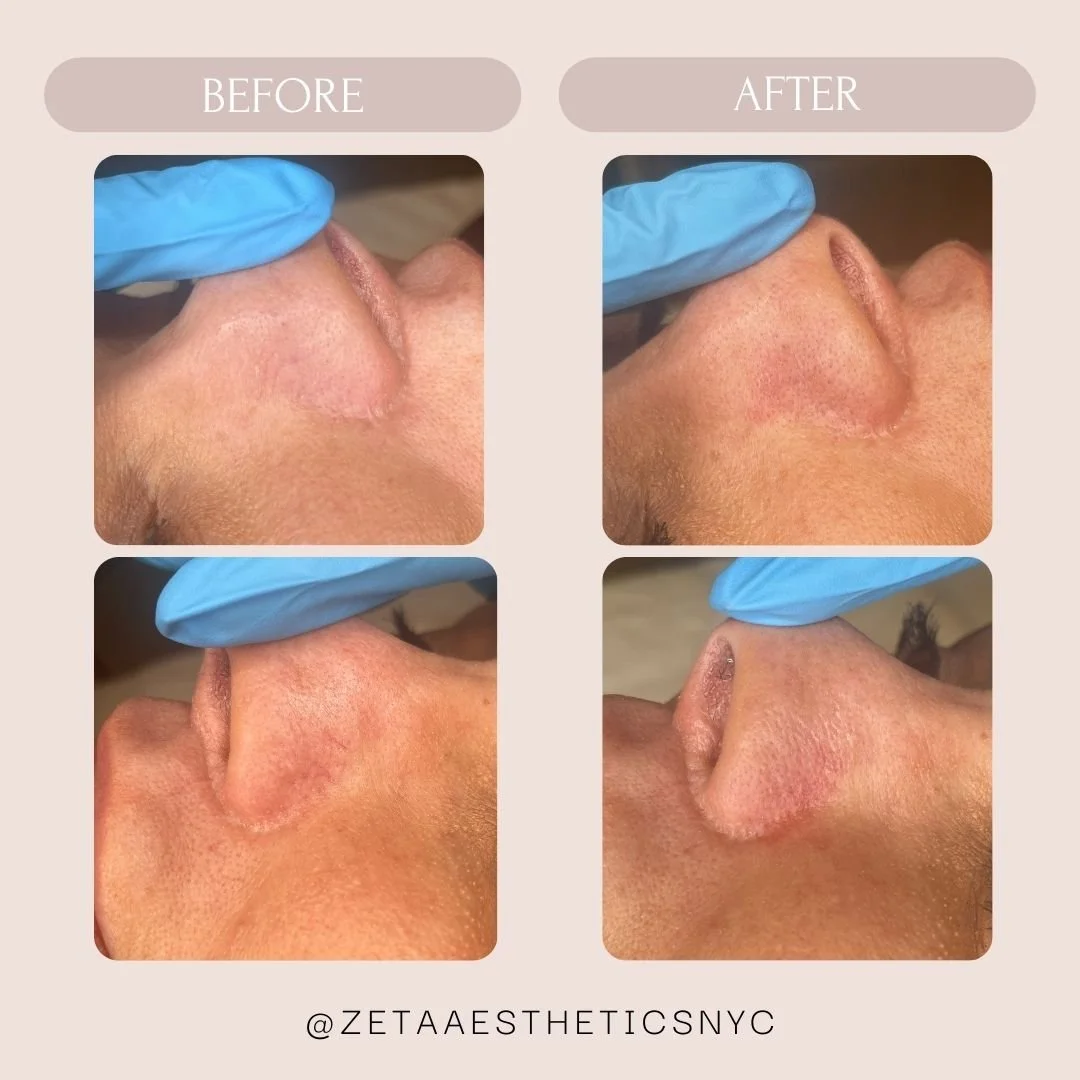 Facial Vein Beofre_After.jpg