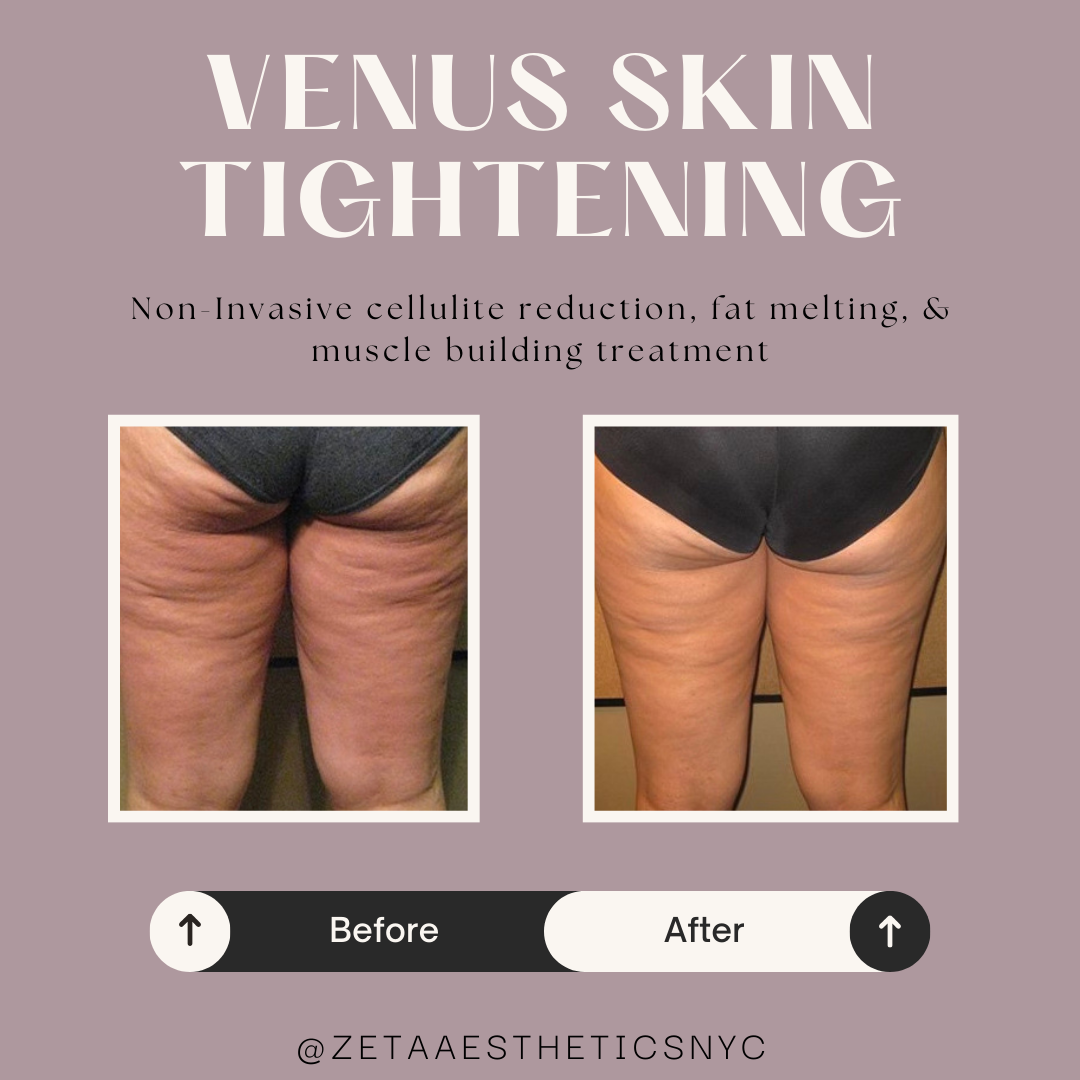 venus skin tightening.png