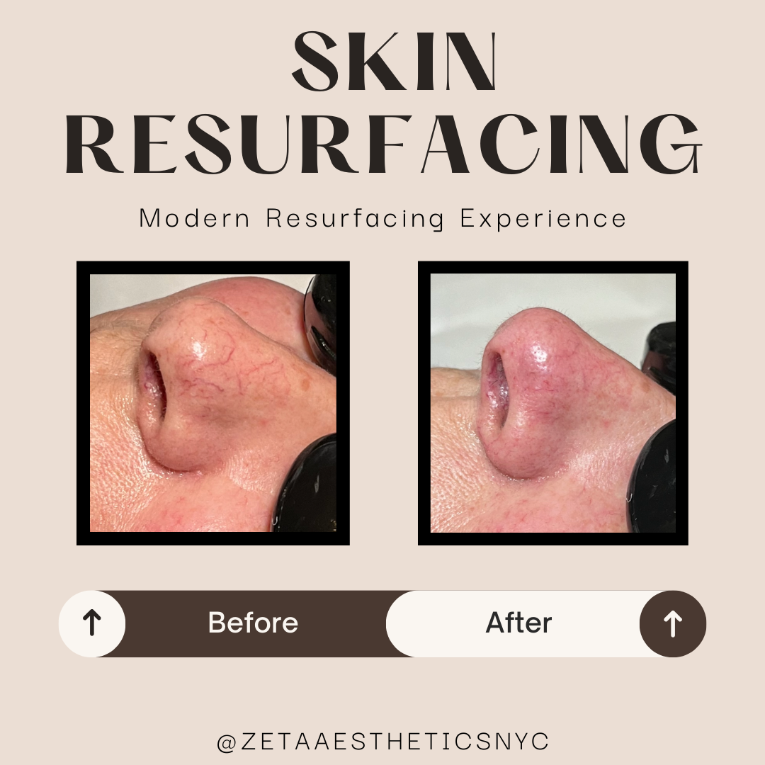 areolase nose B&A.png