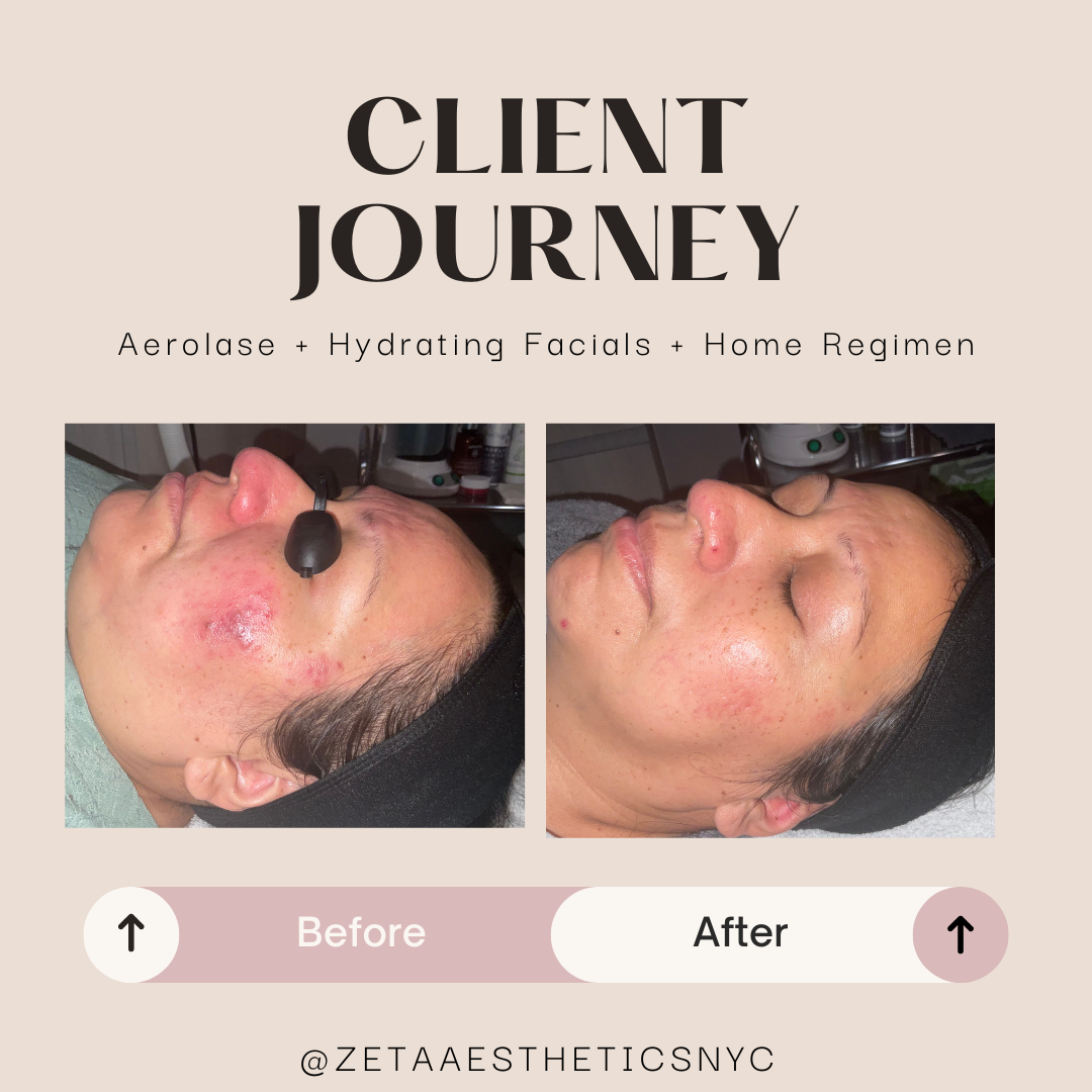 Beforeafter Client severe rosacea.png