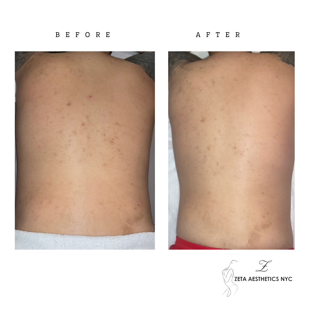 Male Back BeforeAfter.png