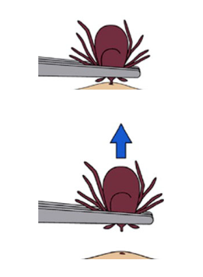 Tick Paralysis