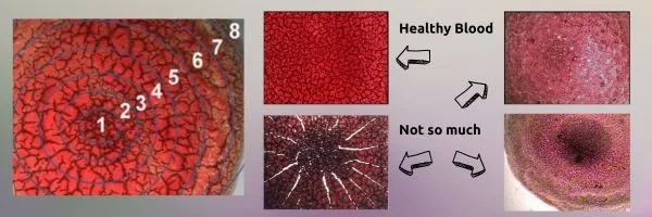 Dry Blood Pics
