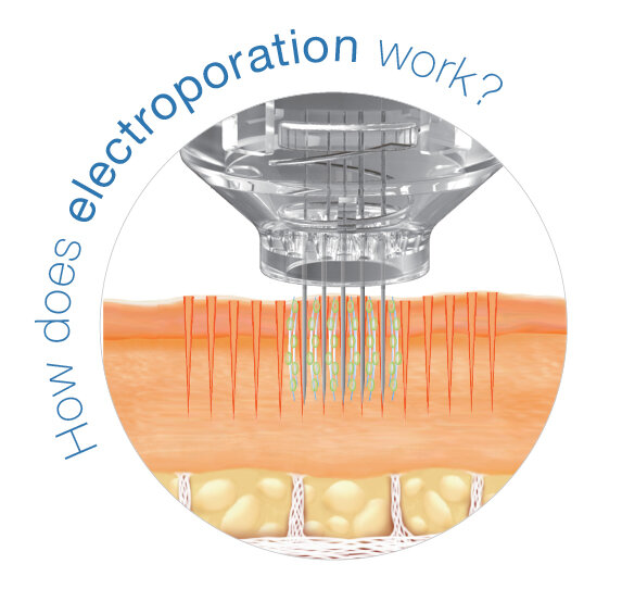 EPN Electroporation