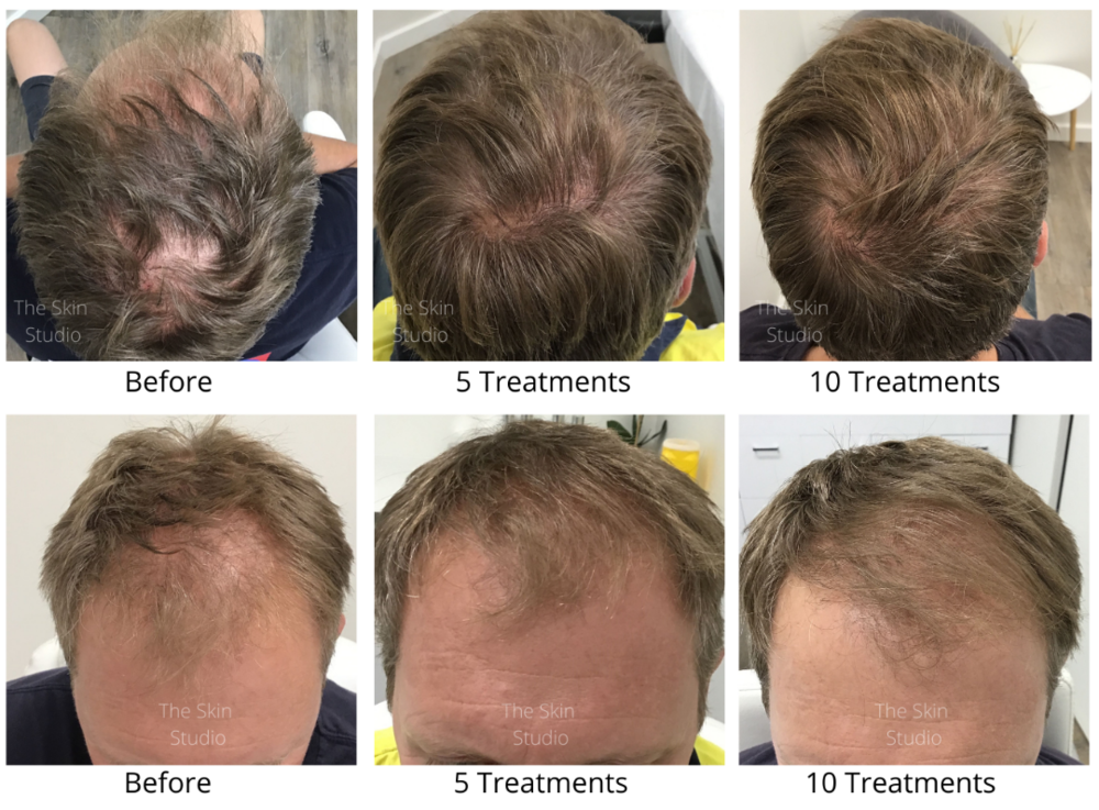 The Most Advanced Hair Loss Treatment available in Australia — Professional  Beauty Solutions