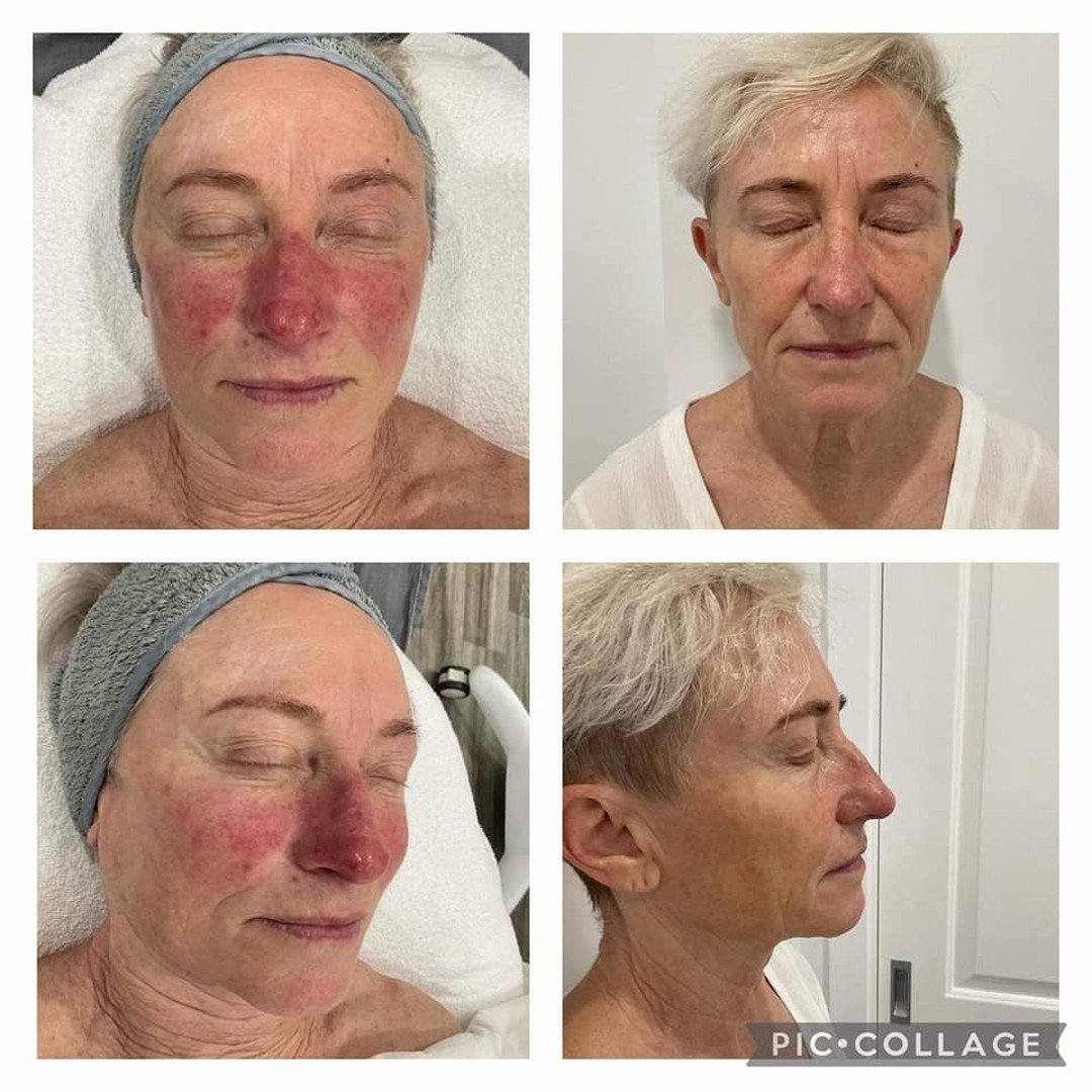 4 Treatments | Credit: Bec’s Skin &amp; Beauty