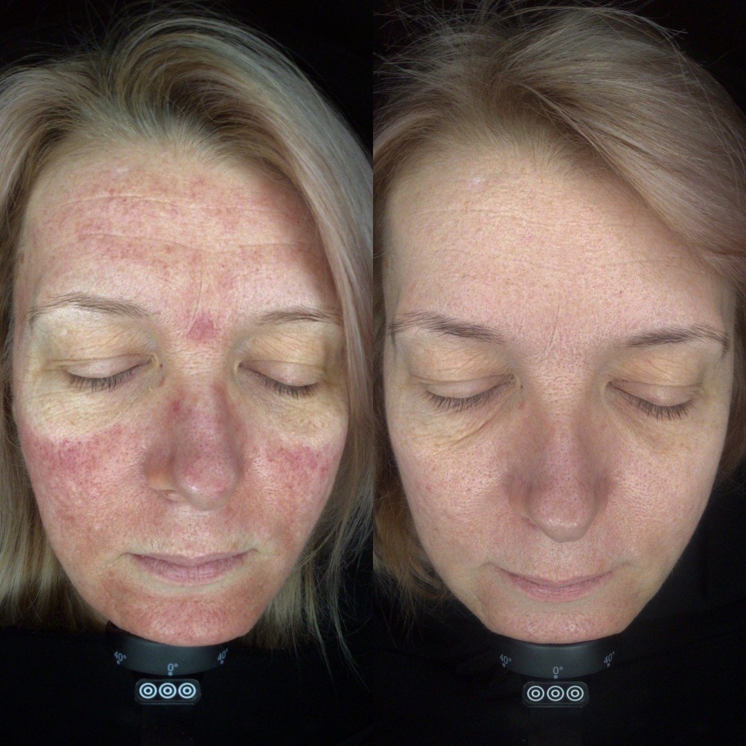 4x F-XFC &amp; F-MesoMatrix Treatments | Credit: @face.mediskin