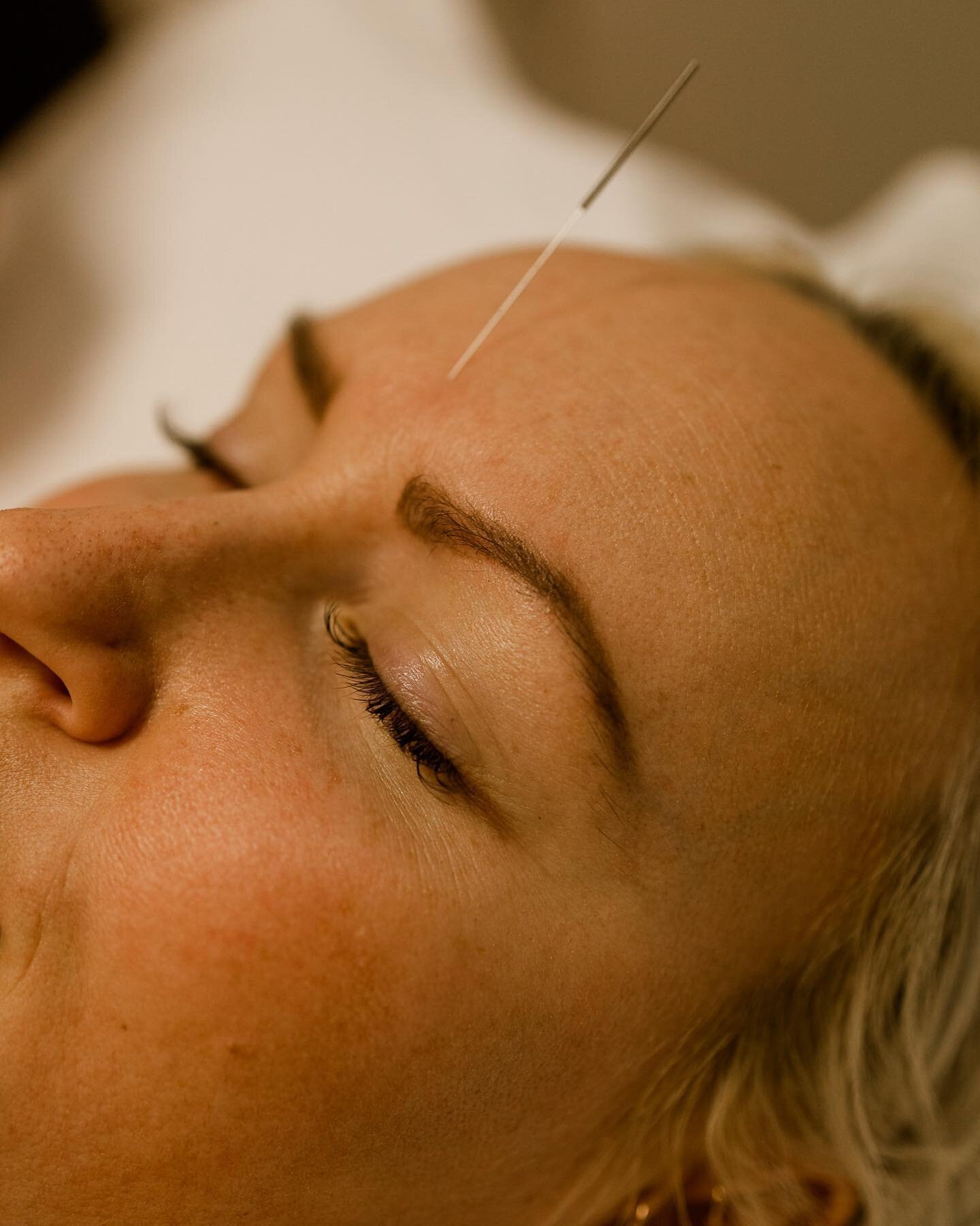An acupuncture needle is as thin as a string of human hair, and as powerful as medication in treating health concerns.

These small yet mighty needles aid your body in the production of natural painkilling chemicals, increasing your blood flow and de
