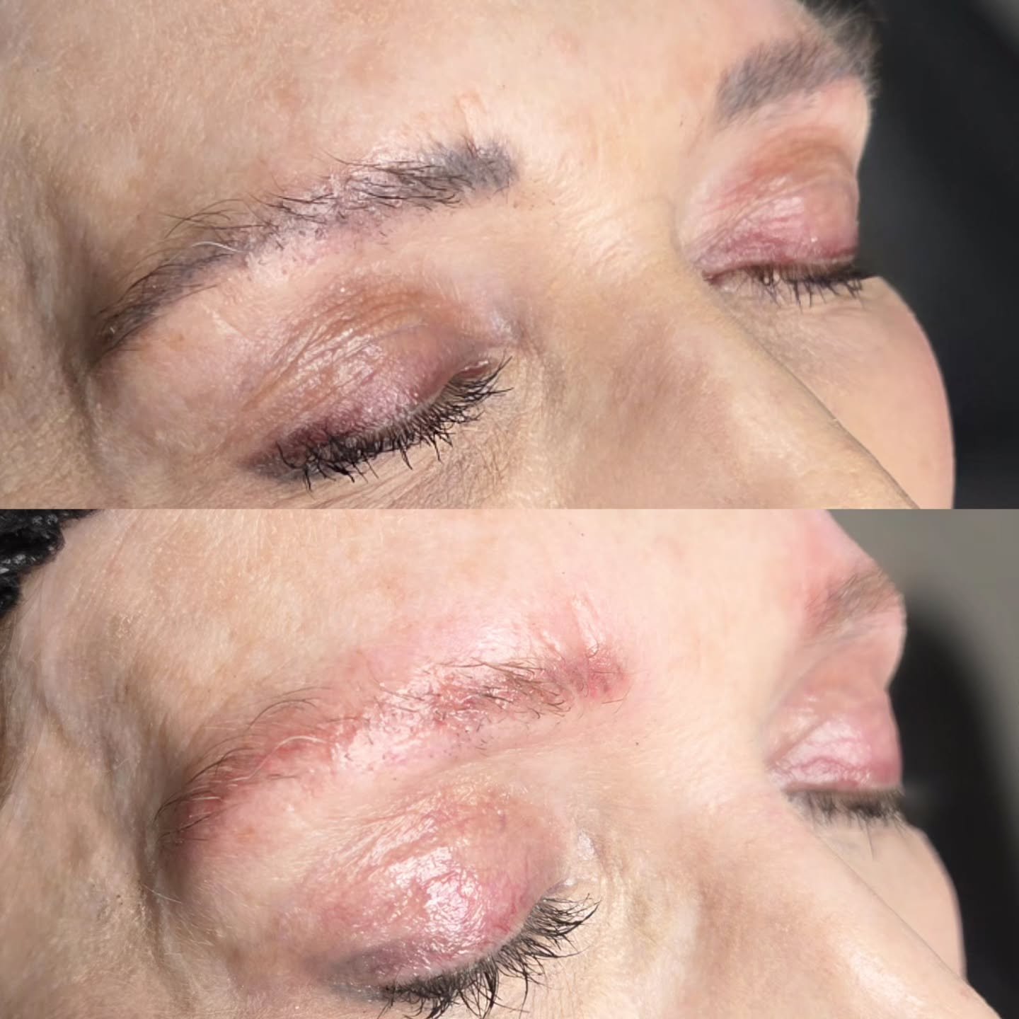 REVERSE &amp; RENEW ⚡

This client came to me as she had microblading elsewhere earlier this year that she was unhappy with. She asked if I could help&mdash;YES! Yes, I can. 🙂

After just one session of laser, the majority of the pigment has gone, s