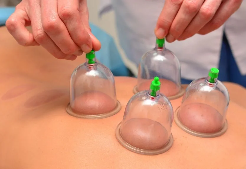 Cupping Therapy may be used to bring relief from stress,pain, allergies, fatigue, flu, colds, back pain, anxiety, muscle aches, red itchy skin conditions or fever, improve cellulite and acne. If it wasn't for the overwhelming media coverage of the cupping marks on M Phelps' shoulders , who would tell us! Oh, may be WSJ or NYT , for sure. It's an ancient TCM method with profound and versatile effects. The Cupping technique ( with or without magnets) is integrated In the massage session following the principles of Lymph circulation and according to the individual patient's needs.