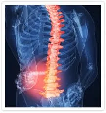 Damage to nervous tissue of spinal cord