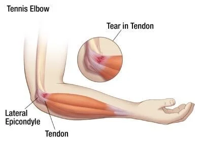 How come everyone has Tennis Elbow?