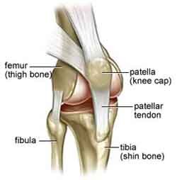 Patellar Tendonitis (Jumper's Knee)  Central Coast Orthopedic Medical Group