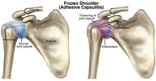 Do you really have Frozen Shoulder?