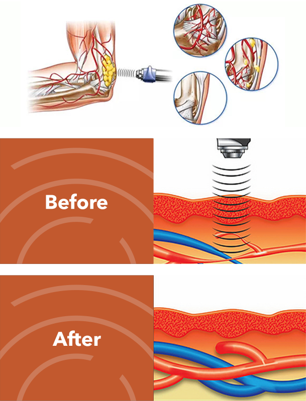 Shockwave therapy Singapre