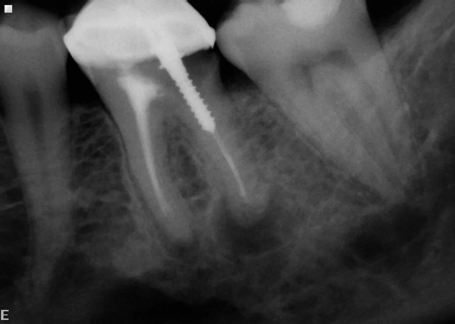Before: Decay and infection under crown