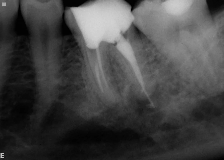 After: Re-root treatment