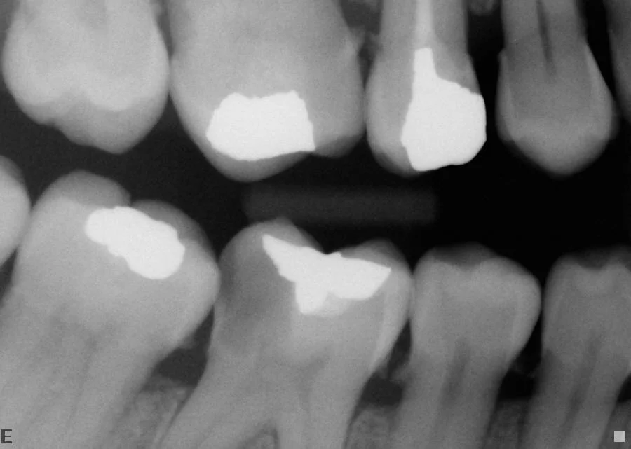 Before: Decayed lower molar