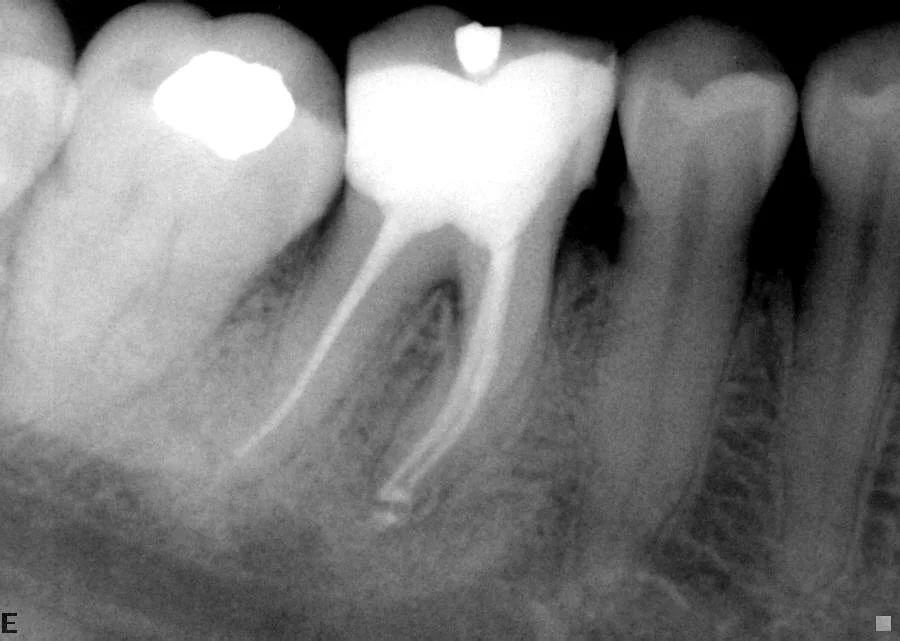 After: Root-treated lower molar
