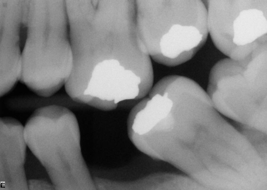 Case Study: Tilted lower molar
