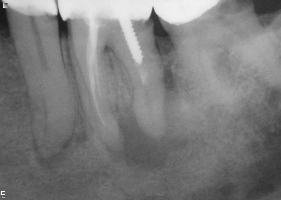 Before: Infected lower left teeth