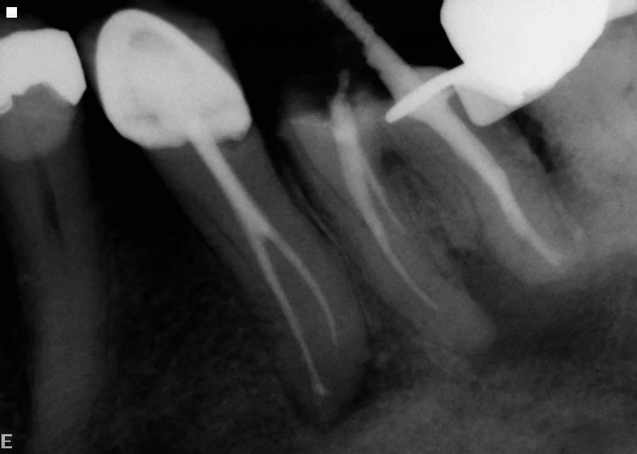 After: Infected lower left teeth