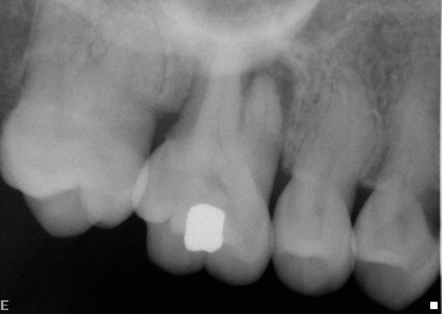 Before: Infected upper right molar