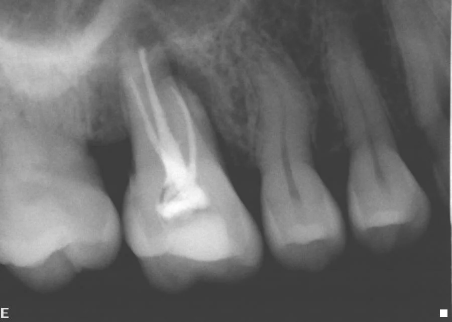 After: Infected upper right molar
