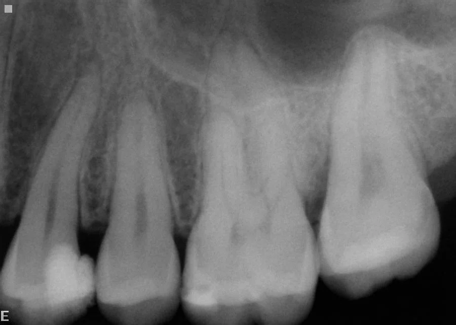 Before: Upper Left Premolar