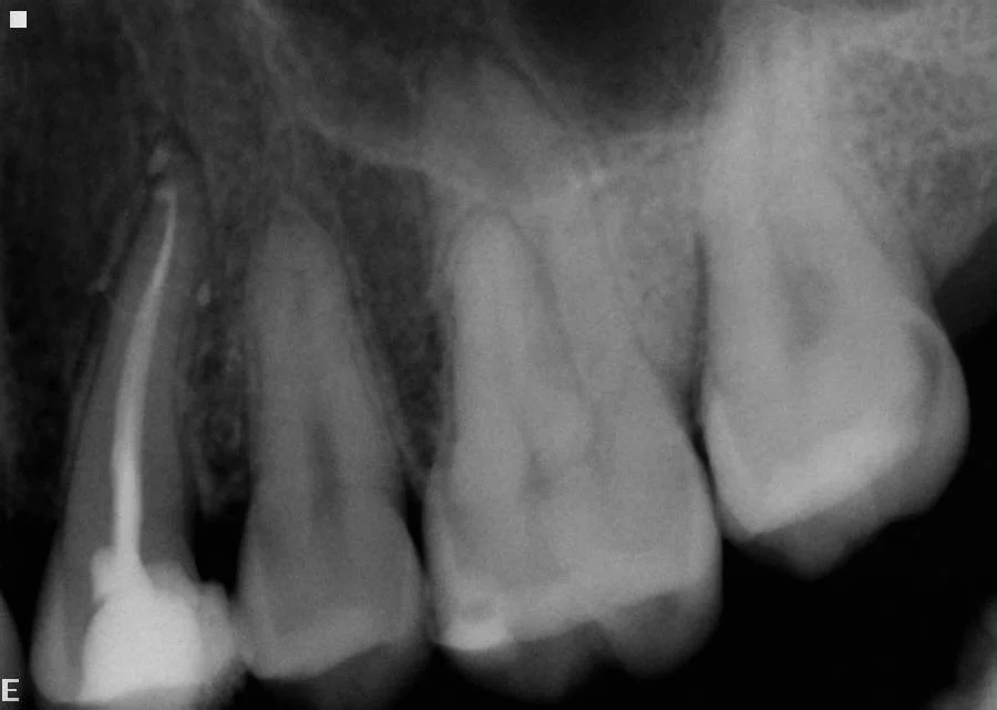 After - Upper Left Premolar