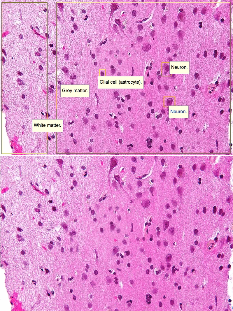 Close-up of the brain. Left: white matter. Right: Grey matter, Glial cell and Neurons. Source: Nephron.
