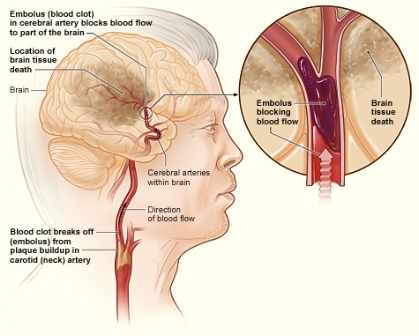 Picture of ischemic stroke. Source: National Heart, Lung and Blood Institute, National Institutes of Health