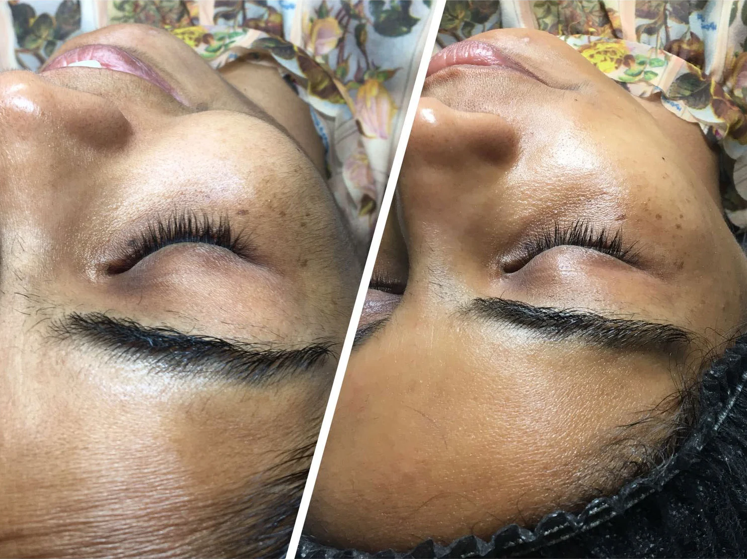 dermaplaning-in-bristol-clifton.jpg