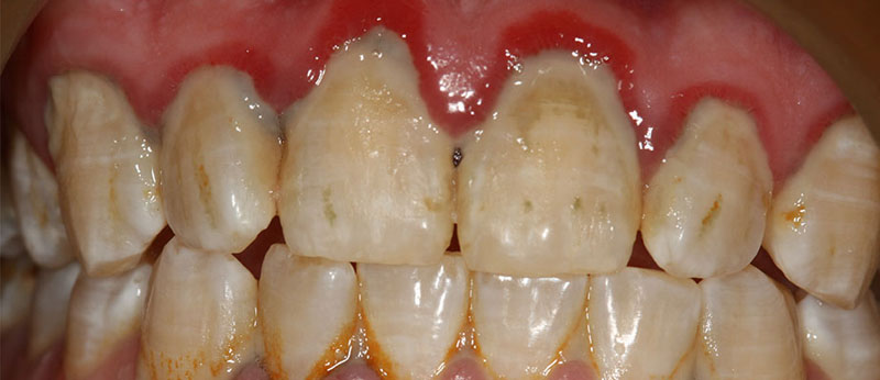 In this picture we can see lots of build up and plaque around teeth specially upper front ones which caused inflammation and redness in the gum next to the teeth. This can be Gingivitis or Periodontitis. The difference between gingivitis and periodontitis is in presence or absence of periodontal pocket. If the gap between gum and tooth gets deeper than 3mm then it is called periodontitis. That gap is called periodontal pocket. If there is no periodontal pocket and gum has inflammation then it is called gingivitis.