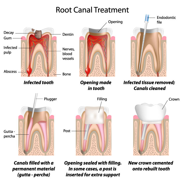 Above picture shows some stages of a root canal treatment. When pulp tissue is infected, it will be removed and canals will be cleaned with filing the canal walls, widening then, shaping them and then will be filled and sealed with “Gutta Percha” and sealer. If we don’t fill the canals and leave them empty, even if they are cleaned, they will get infected again later. Any empty space in body with no blood supply is a good place for bacteria to hide, reproduce and cause infection.