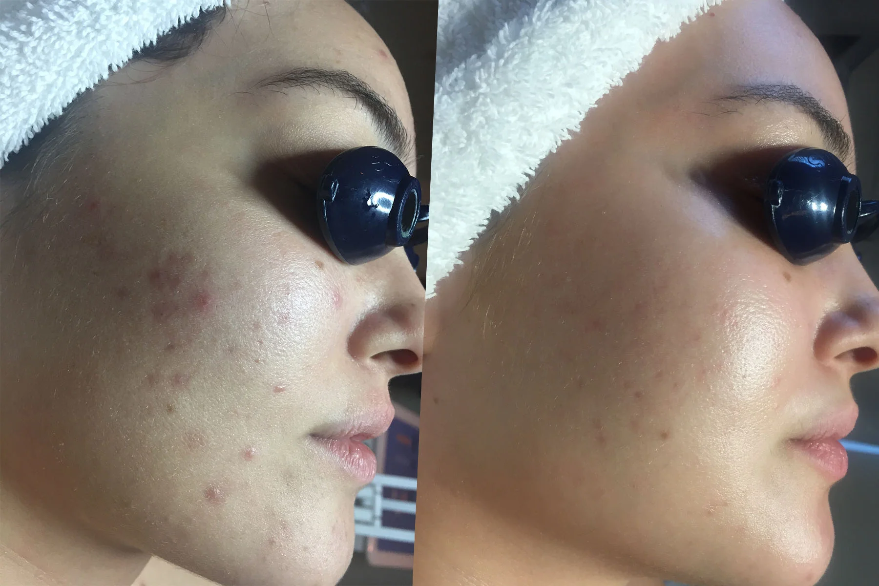 chemical peel side.jpg