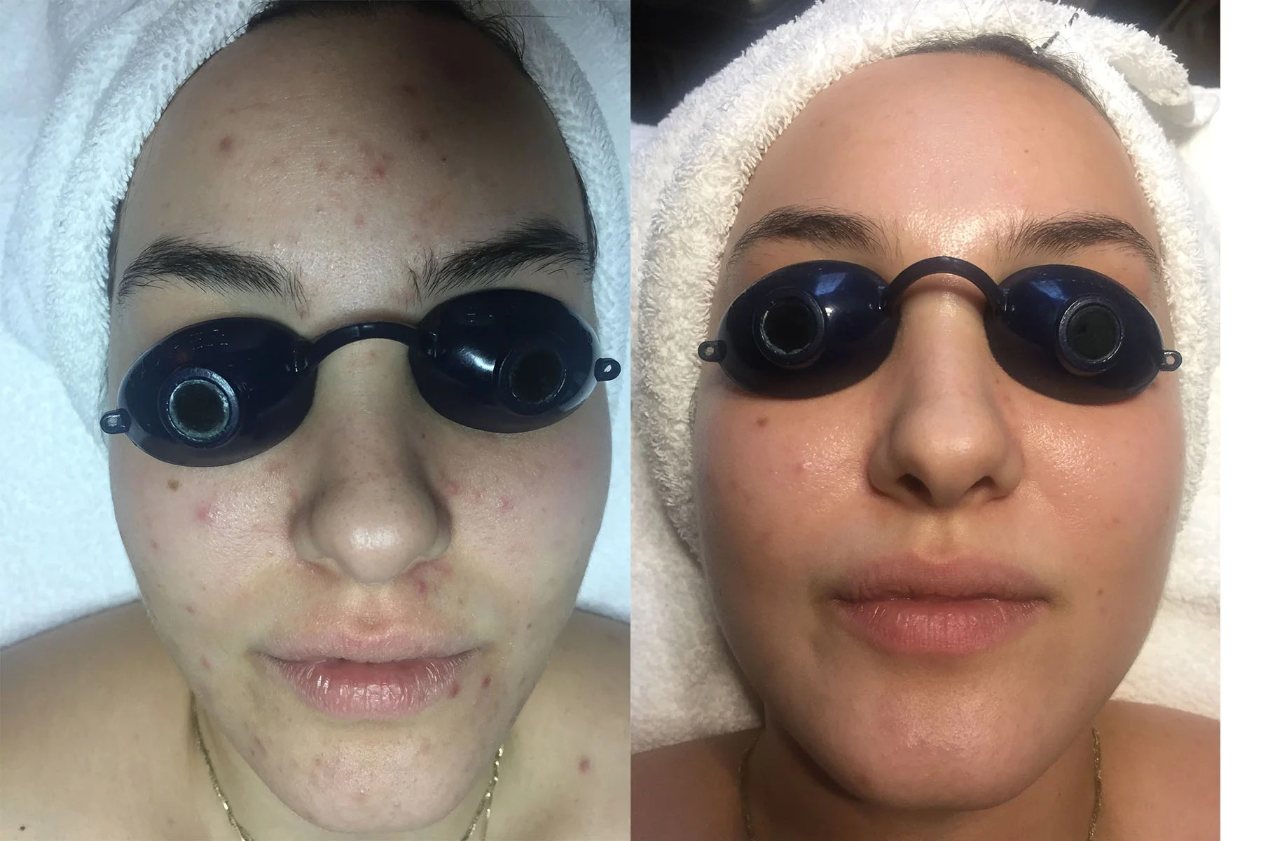 Chemical Peel for Acne.jpg