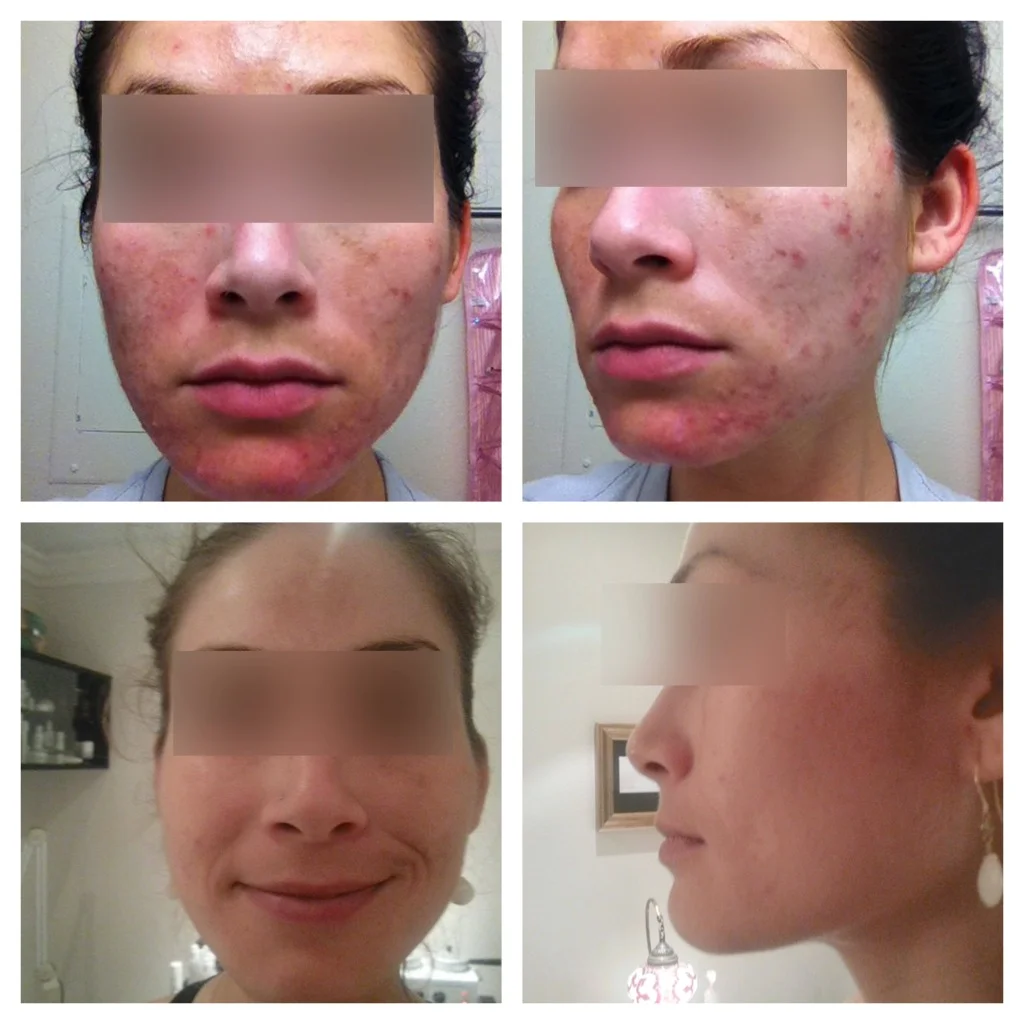 acne and pigmentation.jpeg